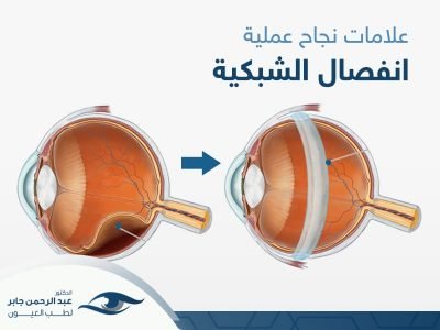 علامات-نجاح-عملية-انفصال-الشبكية-مع د عبد الرحمن جابر علامات نجاح عملية انفصال الشبكية