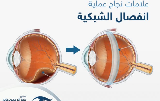 علامات نجاح عملية انفصال الشبكية