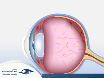 علاج انفصال السائل الزجاجي في العين