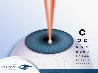 عملية الليزك للعيون عملية الليزك للعيون