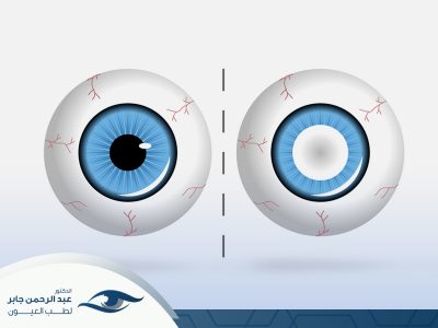 عملية المياه البيضاء