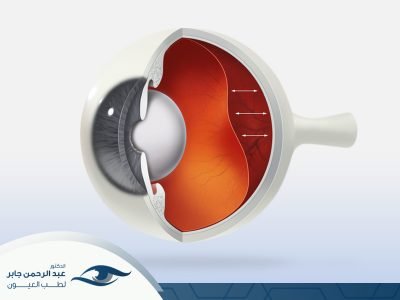 عملية انفصال الشبكية