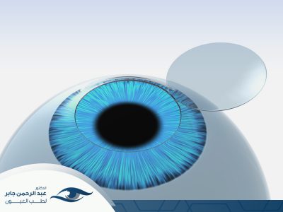 عملية-زرع-قرنية عملية زرع القرنية