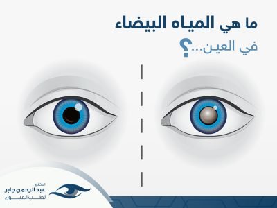 ما-هي-المياه-البيضاء-في-العين ما هي المياه البيضاء