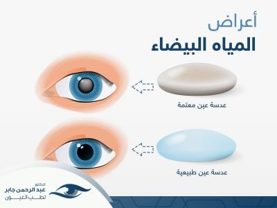 اعراض-المياة-البيضاء اعرفها مع د عبد الرحمن جابر اعراض-المياة-البيضاء اعرفها مع د عبد الرحمن جابر