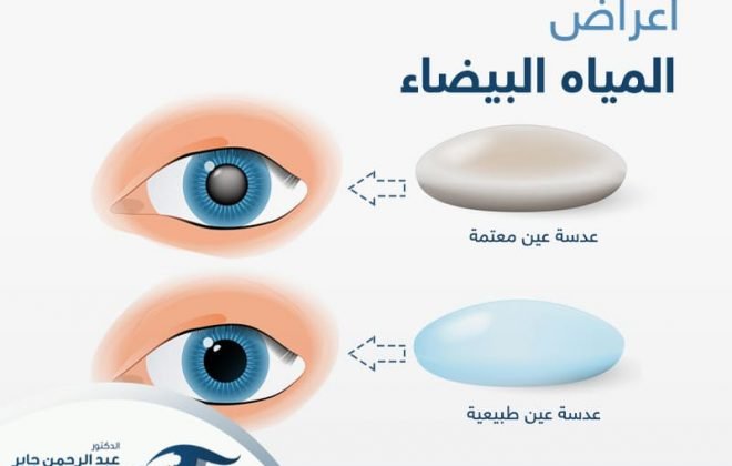 اعراض-المياة-البيضاء اعرفها مع د عبد الرحمن جابر