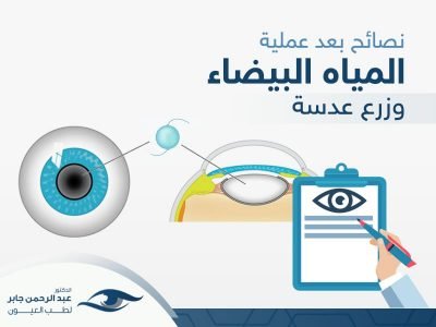 نصائح-بعد-عملية-المياة-البيضاء-وزرع-عدسة د عبد الرحمن جابر نصائح بعد عملية المياة البيضاء وزرع عدسة