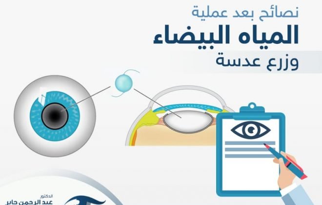 نصائح بعد عملية المياة البيضاء وزرع عدسة