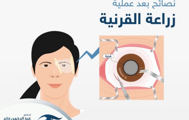 نصائح بعد زراعة القرنية