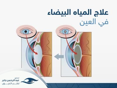 علاج-المياه-البيضاء-في-العين علاج المياه البيضاء في العين