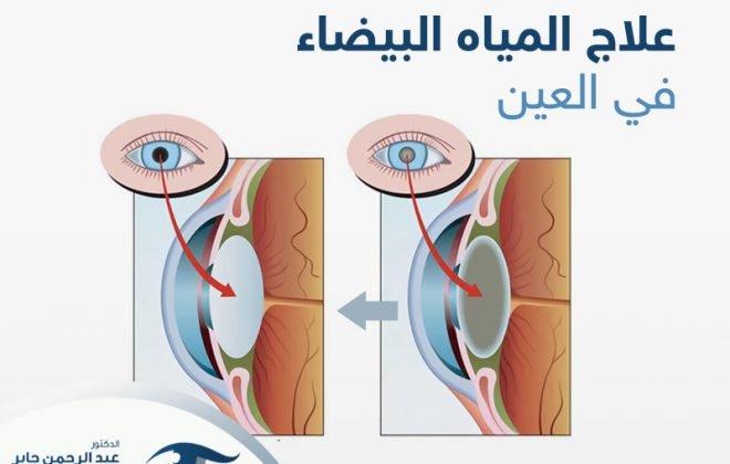 علاج المياه البيضاء في العين