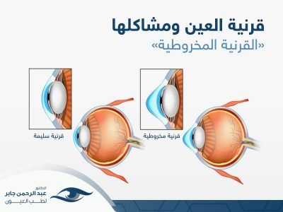 قرنية العين ومشاكلها - عبد الرحمن جابر قرنية العين ومشاكلها - عبد الرحمن جابر