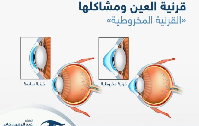 قرنية العين ومشاكلها - عبد الرحمن جابر