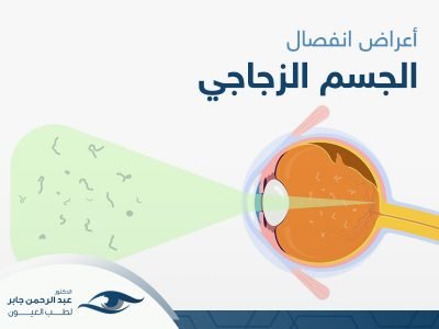 اعراض-انفصال-الجسم-الزجاجي اعراض انفصال الجسم الزجاجي
