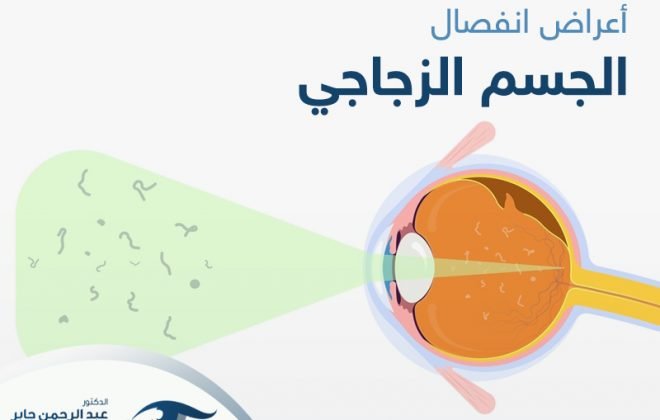 اعراض انفصال الجسم الزجاجي