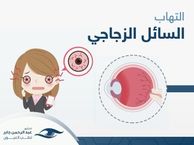 التهاب-السائل-الزجاجي-في-العين (1) التهاب السائل الزجاجي في العين