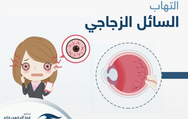 التهاب السائل الزجاجي في العين