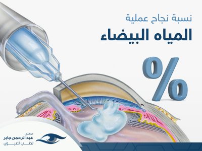 نسبة-نجاح-عملية-المياه-البيضاء (1) نسبة نجاح عملية المياه البيضاء