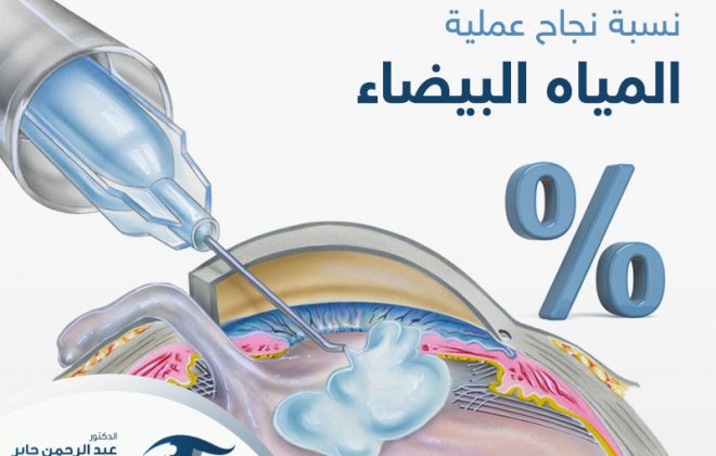 نسبة نجاح عملية المياه البيضاء