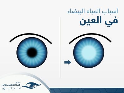 اسباب المياه البيضاء في العين