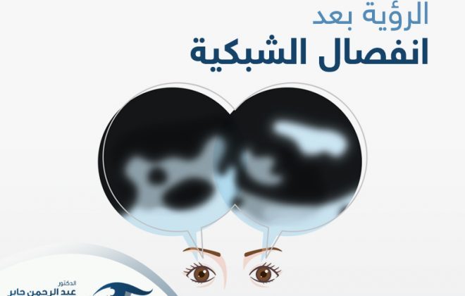 الرؤية بعد انفصال الشبكية