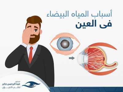 اسباب تكون المياه البيضاء في العين