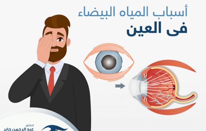 اسباب تكون المياه البيضاء في العين