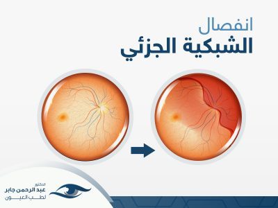انفصال الشبكية الجزئي