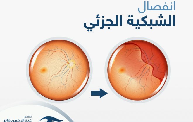 انفصال الشبكية الجزئي