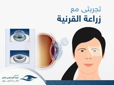 تجربتي مع زراعة القرنية