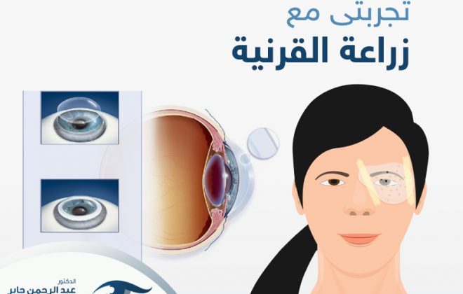 تجربتي مع زراعة القرنية