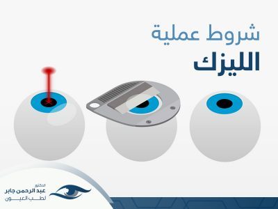 شروط عملية الليزك