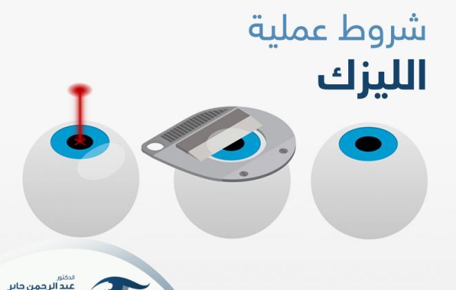 شروط عملية الليزك