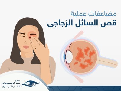 مضاعفات عملية قص السائل الزجاجي