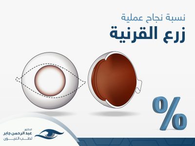 نسبة نجاح عملية زرع القرنية