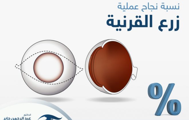 نسبة نجاح عملية زرع القرنية