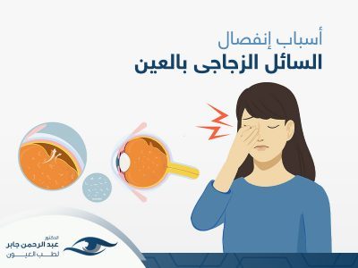 اسباب انفصال السائل الزجاجي في العين