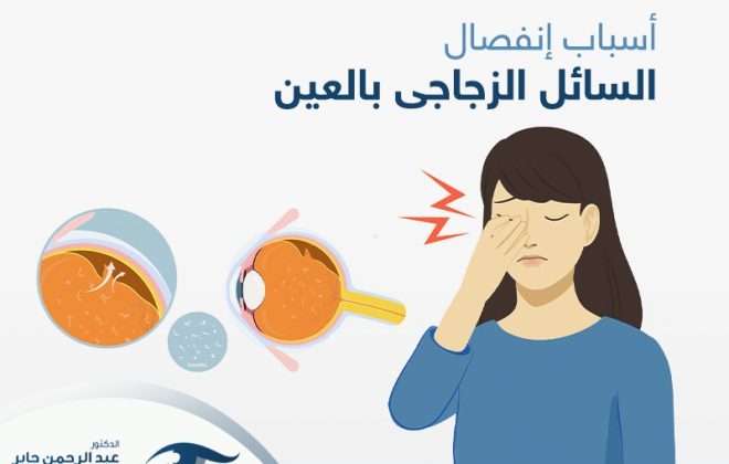 اسباب انفصال السائل الزجاجي في العين